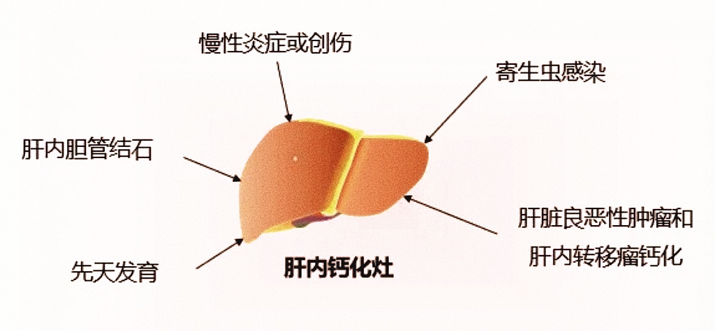 超声知识点 | 体检查出“肝内钙化灶”，是硬化还是癌症前兆？