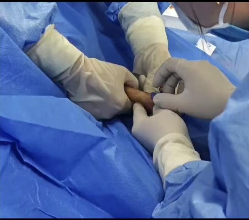 为1540克早产宝宝打通 “生命之桥”！我院首例新生儿PICC置管成功